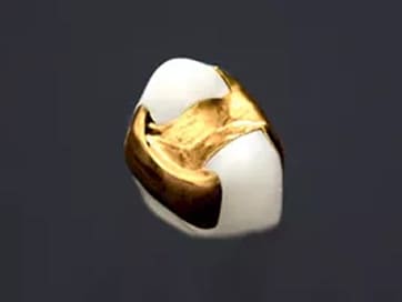 ゴールドインレー(大臼歯・咬合面のみ)